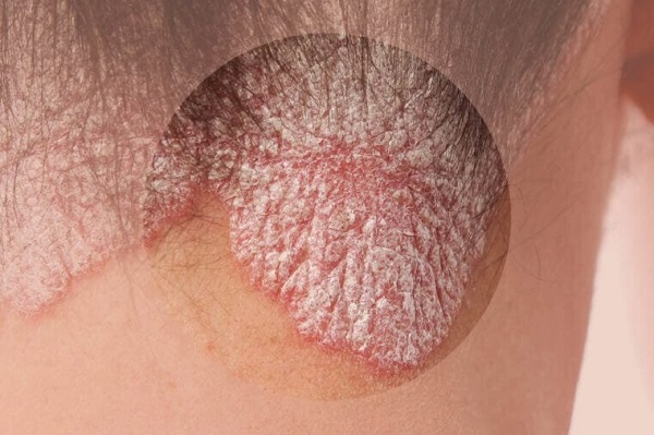 رابطه استرس و شرایط پوست رابطه استرس و شرایط پوست