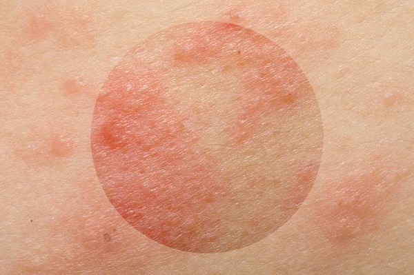 رابطه استرس و شرایط پوست رابطه استرس و شرایط پوست