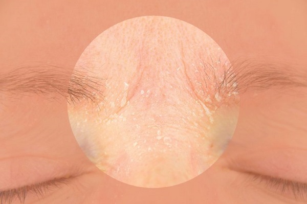 رابطه استرس و شرایط پوست رابطه استرس و شرایط پوست