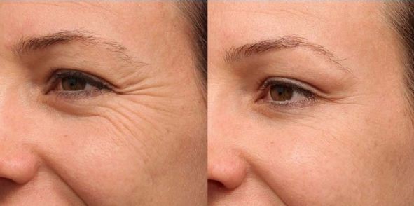 تزریق ژل لب طبیعی در کلینیک پوست و مو رز تزریق ژل لب طبیعی در کلینیک پوست و مو رز