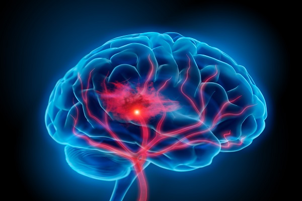 سه گانهای برای پیشگیری از سکته مغزی! سه گانهای برای پیشگیری از سکته مغزی!