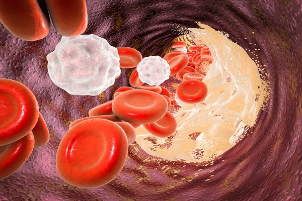 نشانههای خاموش انسداد در سرخرگها نشانههای خاموش انسداد در سرخرگها
