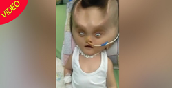 تغییر شکل عجیب صورت نوزاد پس از عمل جراحی! (+عکس) تغییر شکل عجیب صورت نوزاد پس از عمل جراحی! (+عکس)