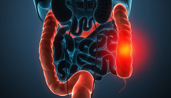 نکتههای اولیه برای پیشگیری از سرطان روده بزرگ نکتههای اولیه برای پیشگیری از سرطان روده بزرگ