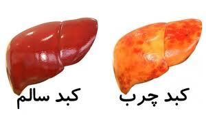 شیوع 2 برابری کبد چرب در کشور شیوع 2 برابری کبد چرب در کشور