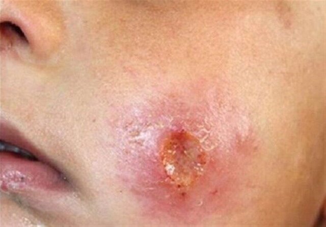 فارس/ افزایش شیوع سالک در جهرم؛ بیماران برای درمان اقدام کنند فارس/ افزایش شیوع سالک در جهرم؛ بیماران برای درمان اقدام کنند