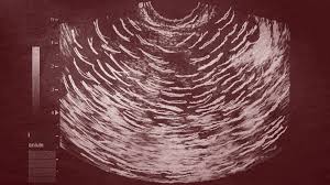 صدور مجور سقط جنین پزشکی برای ۶۶۶ نفر در تهران