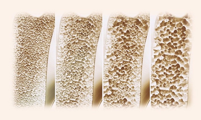 آیا امکان معکوس کردن پوکی استخوان وجود دارد؟ آیا امکان معکوس کردن پوکی استخوان وجود دارد؟