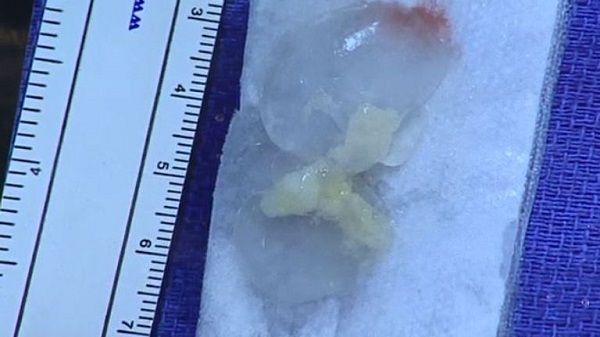 14 سال زندگی با یک کرم نواری در مغز/ 