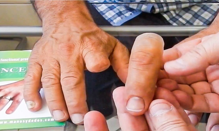 پروتزهایی که زندگی انسان‌ها را تغییر می‌دهند