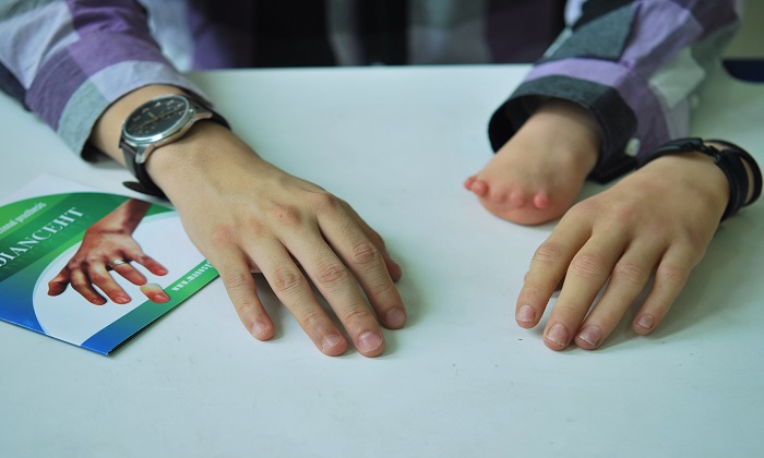 پروتزهایی که زندگی انسان‌ها را تغییر می‌دهند