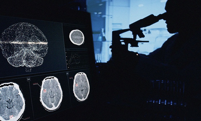 دانستنی‌هایی درباره تومورهای گلیوما