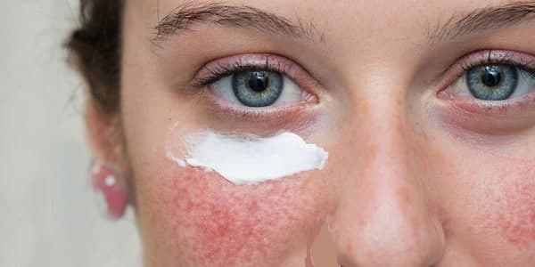 هرآنچه باید درباره روزاسه بدانیم، از علل ریشه ای تا درمان های خانگی