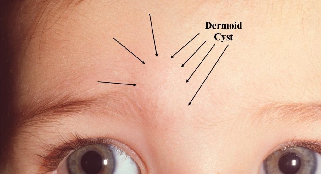 از سیر تا پیاز کیست درموئید از سیر تا پیاز کیست درموئید