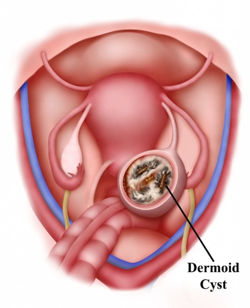 از سیر تا پیاز کیست درموئید از سیر تا پیاز کیست درموئید