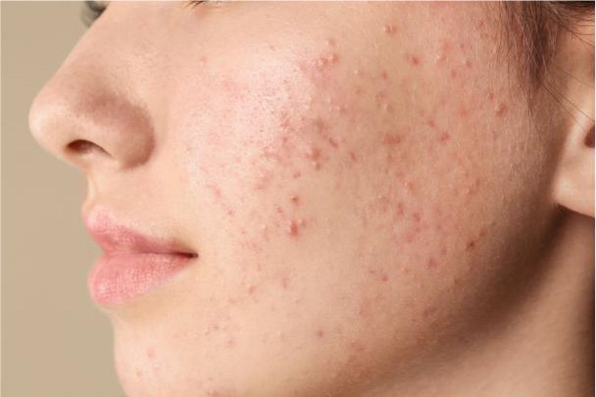 با جای جوش‌ها چه کنیم؟