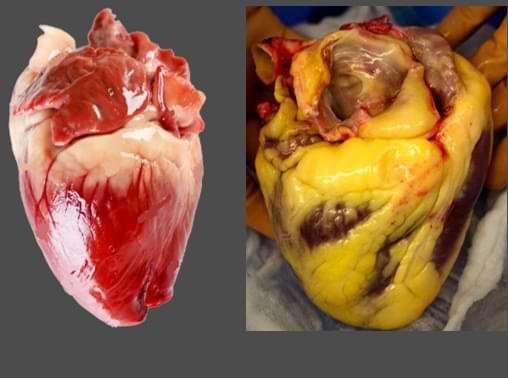 از قلبی که با چربی پوشیده شده تا تهدید سلامت انسان