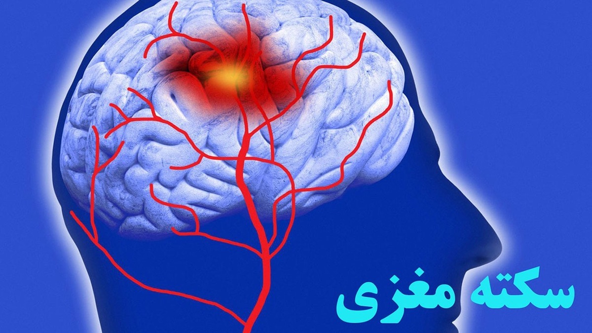 تشخیص سریع سکته مغزی با موبایل