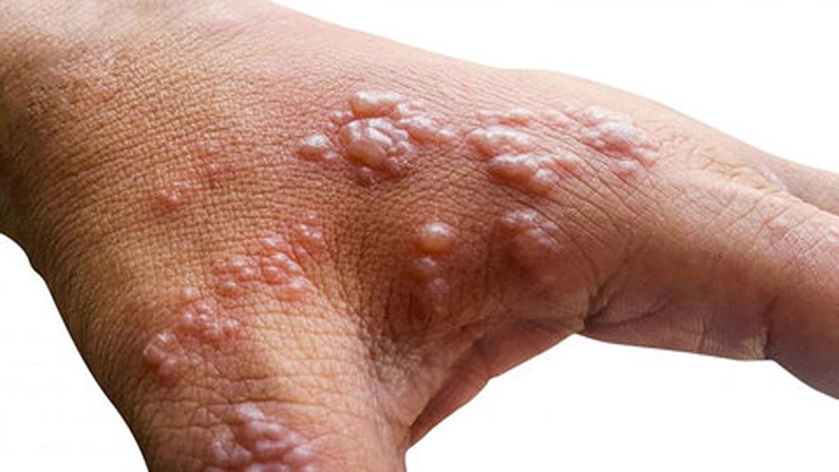 دانشگاه علوم پزشکی: تشخیص ابتلا به آبله میمونی در بابل حتمی نیست / نمونه به تهران ارسال شد
