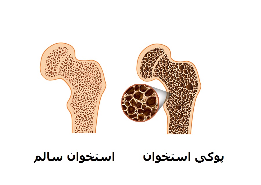همراه با بهترین رژیم غذایی برای بیماران مبتلا به پوکی استخوان همراه با بهترین رژیم غذایی برای بیماران مبتلا به پوکی استخوان