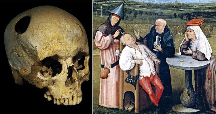 ۱۳ روش درمانی عجیب و غریب در طول تاریخ؛ از خمیر موش تا مربای جنازه