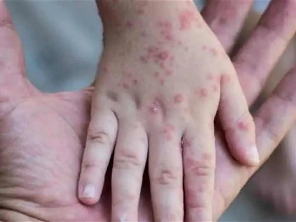 کرم دست و صورت عامل ابتلا به آبله میمون