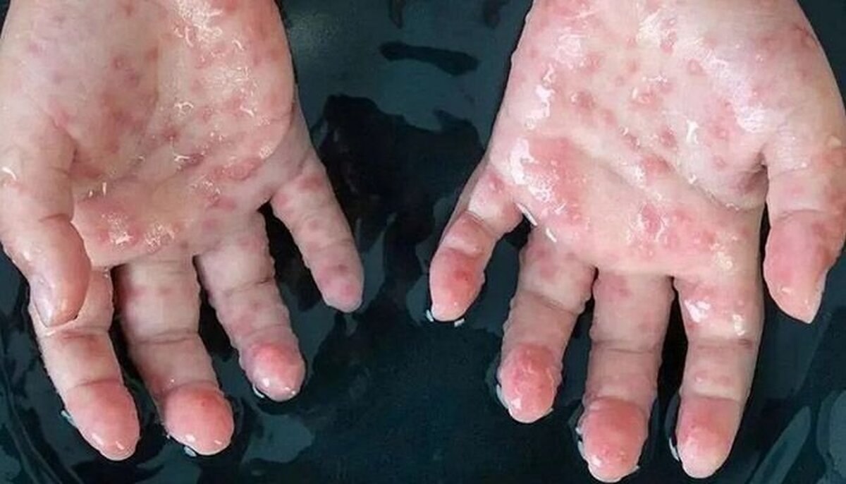 اطلاعاتی جدید درباره آبله میمونی 
