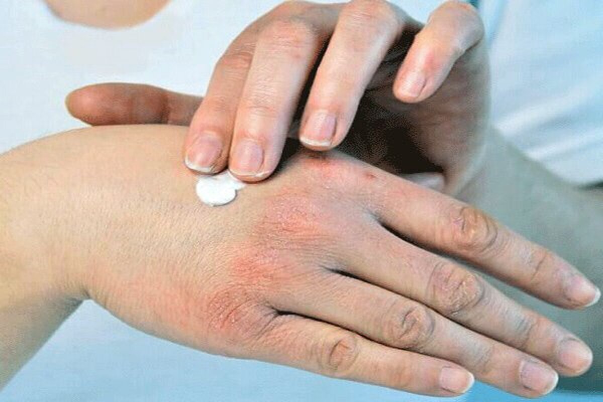 ۷ ماده غذایی برای مقابله با خشکی پوست