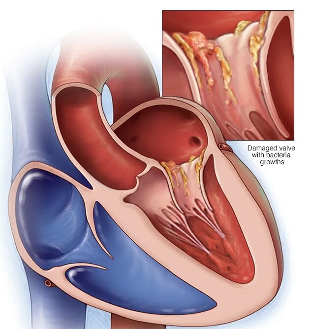 هر آنچه باید در مورد اندوکاردیت بدانیم هر آنچه باید در مورد اندوکاردیت بدانیم