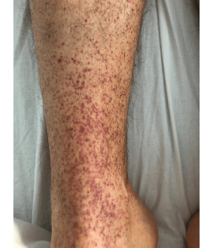 پتشی: علل، علائم و درمان/ چه زمانی به پزشک مراجعه کنیم(+عکس)