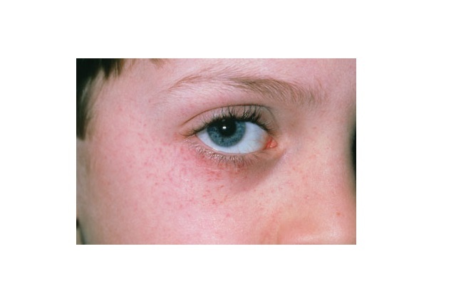 پتشی: علل، علائم و درمان/ چه زمانی به پزشک مراجعه کنیم(+عکس)