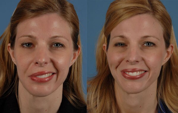 هرآنچه باید در مورد سندرم رامسی هانت بدانیم