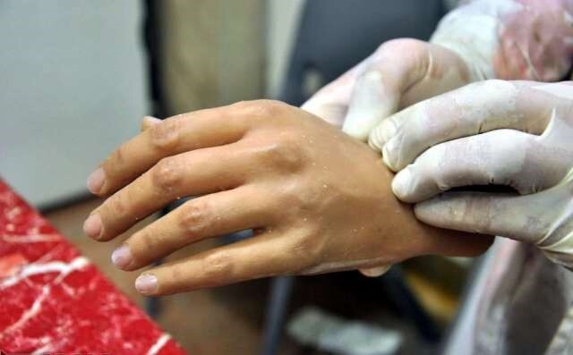 پروتز پا: انواع پای مصنوعی و نحوه سفارش پروتز پا: انواع پای مصنوعی و نحوه سفارش