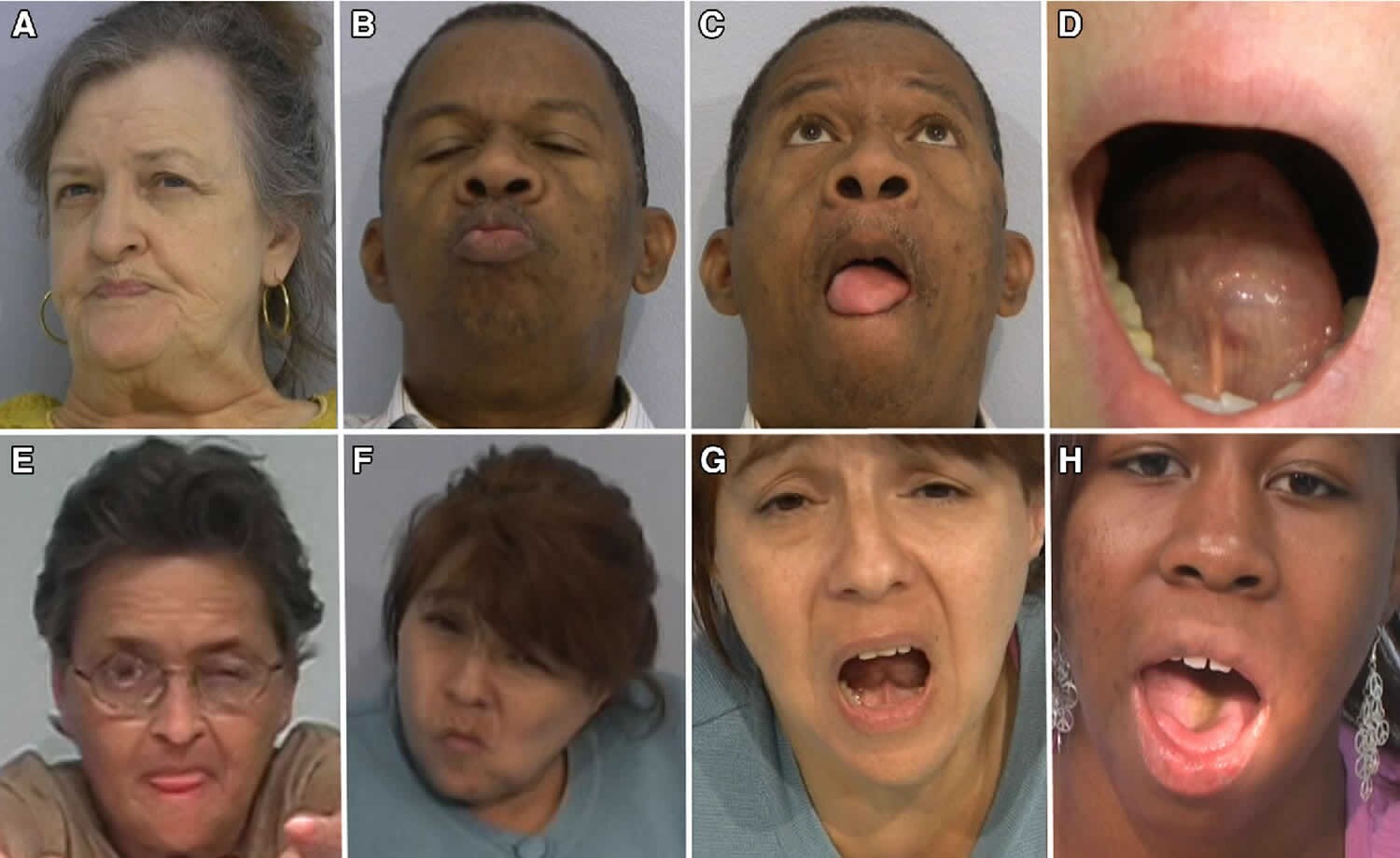 بیماری دیسکینزی چیست؟ حرکات غیر ارادی بدن بیماری دیسکینزی چیست؟ حرکات غیر ارادی بدن