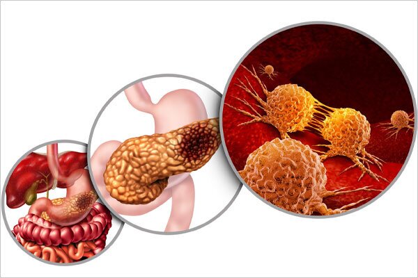 ۳ سرطان کشندهای که باید زود تشخیص داده شوند/ این علائم را جدی بگیرید ۳ سرطان کشندهای که باید زود تشخیص داده شوند/ این علائم را جدی بگیرید