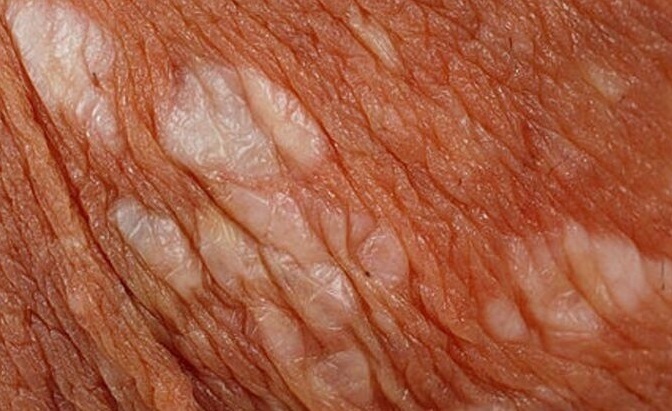 لیکن اسکلروز؛ اختلال التهابی پوست اندام تناسلی / علت، نشانه ها، پیشگری و درمان (+عکس) لیکن اسکلروز؛ اختلال التهابی پوست اندام تناسلی / علت، نشانه ها، پیشگری و درمان (+عکس)