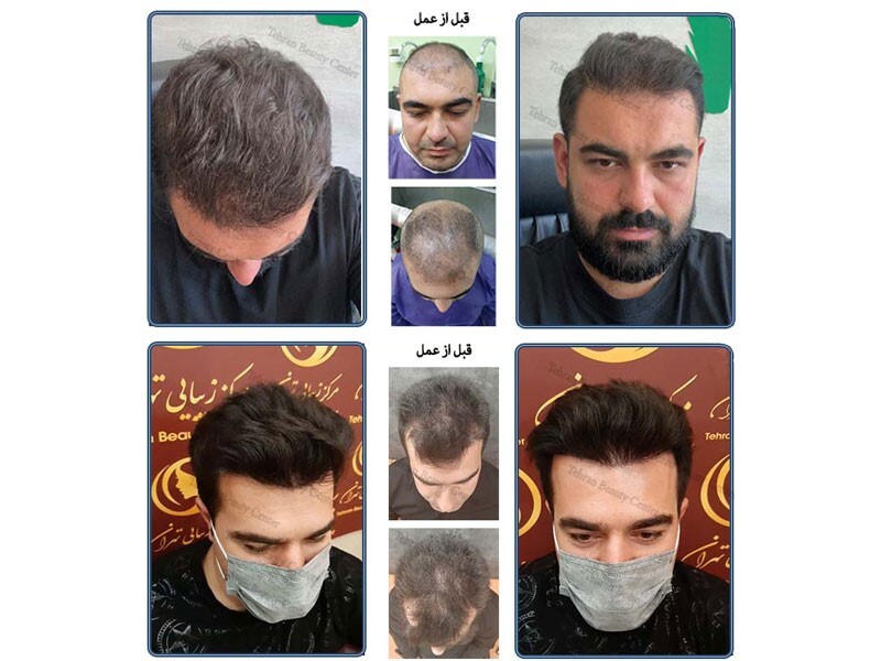 جدیدترین روش های کاشت مو و ابرو در ایران و جهان جدیدترین روش های کاشت مو و ابرو در ایران و جهان