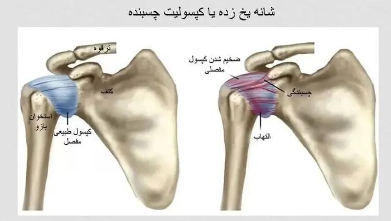 شانه یخزده شانه یخزده