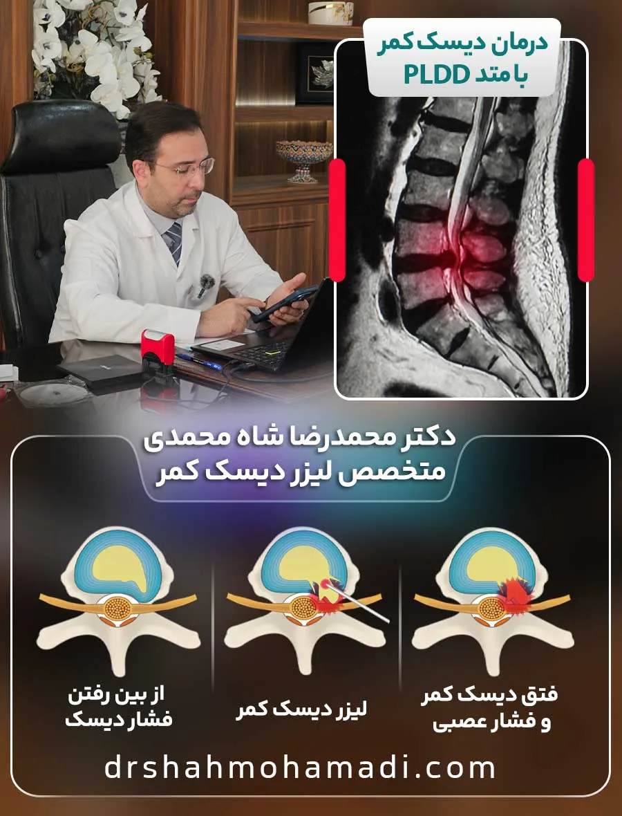 عمل لیزری دیسک کمر (PLDD) چیست؟ - دکتر محمدرضا شاه محمدی جراح لیزر دیسک کمر
