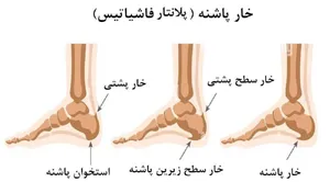 اگر خار پاشنه دارید و از درد آن عاجز شده‌اید، بخوانید