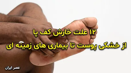 ۱۲ علت خارش کف پا؛ از خشکی پوست تا بیماری های زمینه ای