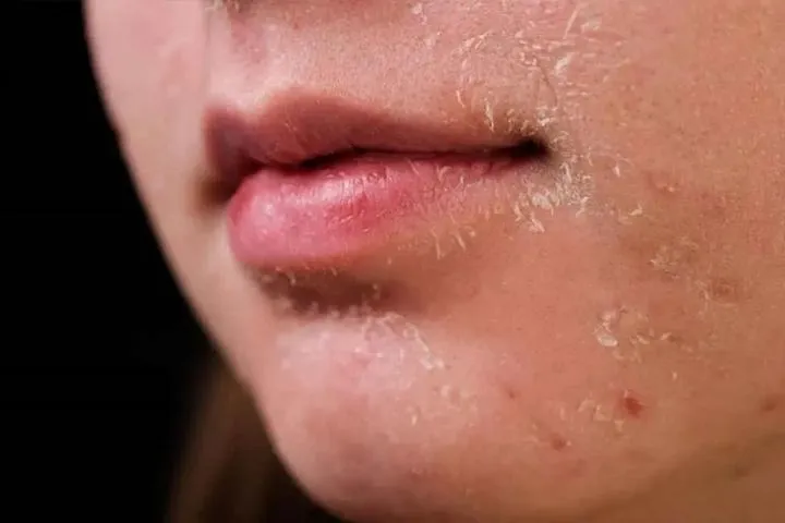 علائم خشکی پوست صورت