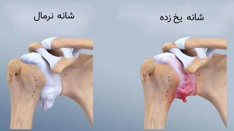 شانه یخزده شانه یخزده