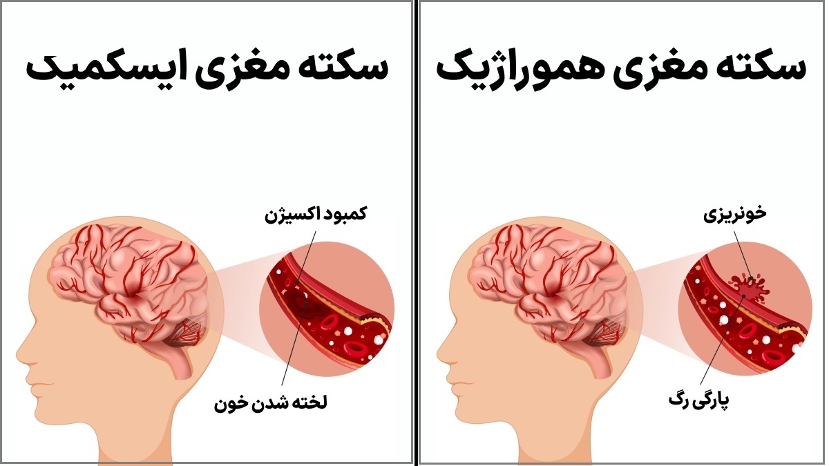 انواع سکته مغزی انواع سکته مغزی